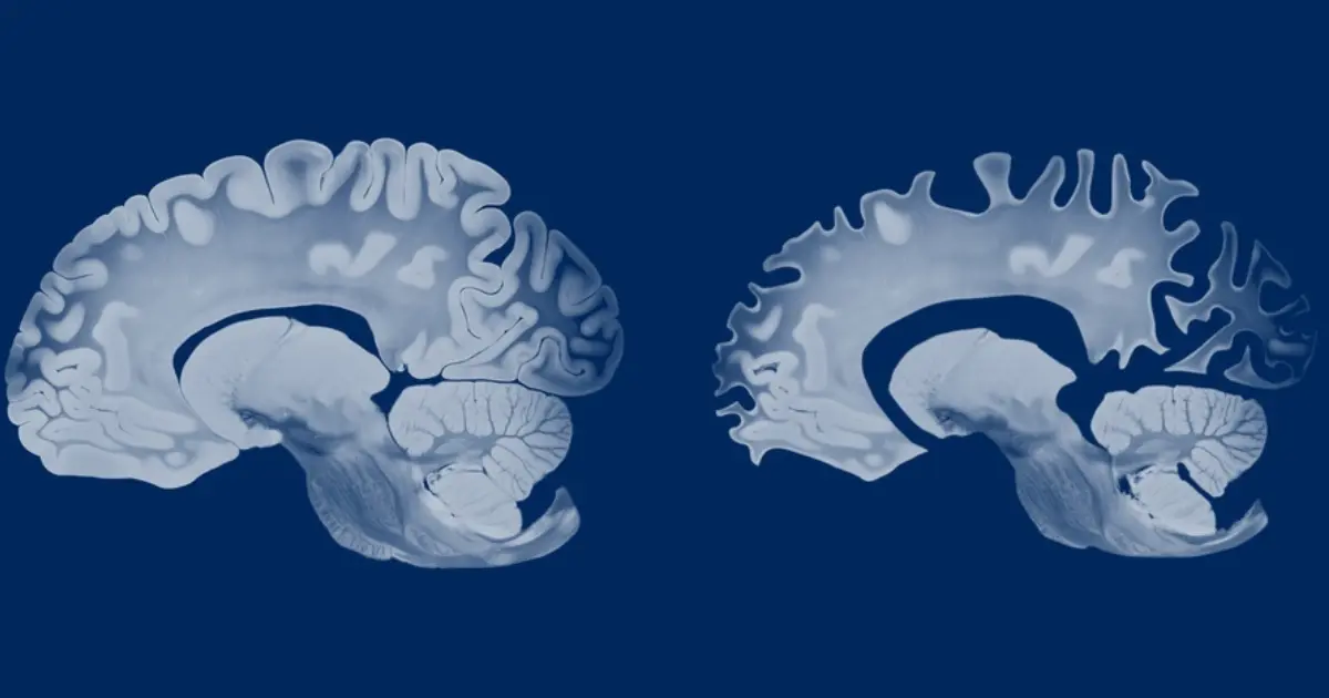 Illustration comparing a healthy young brain and an aged brain showing visible volume loss due to aging and cardiovascular factors.